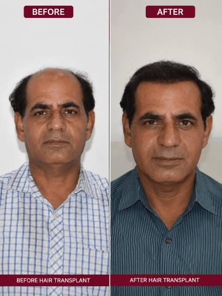 Hair transplant before and after result
