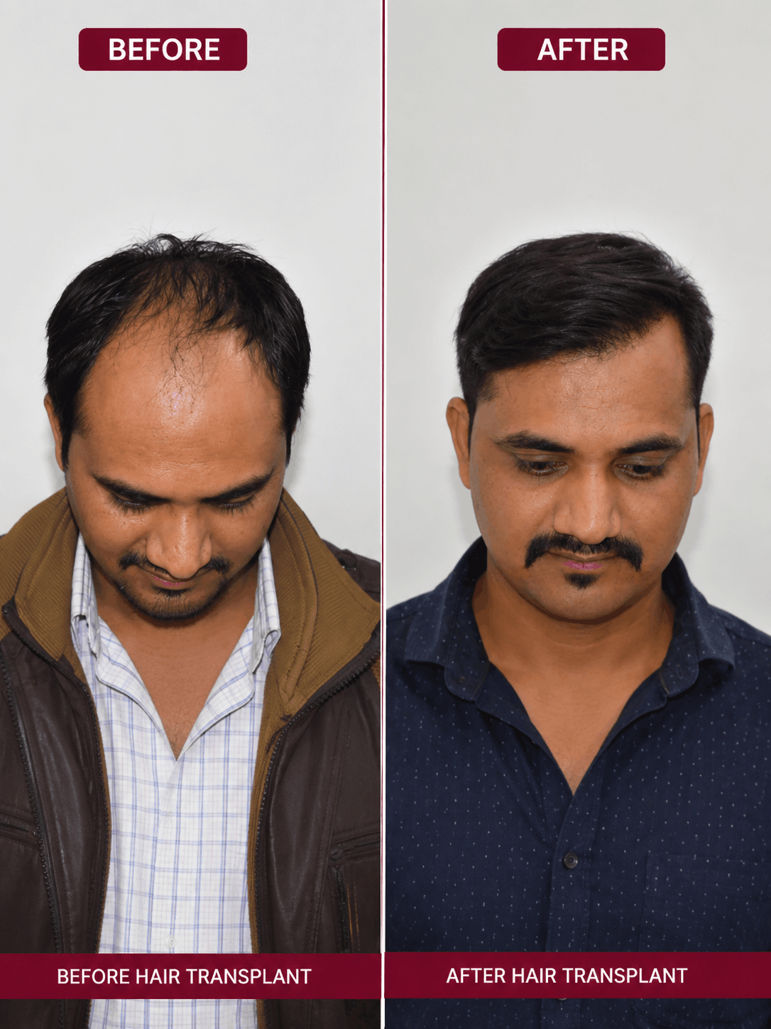 Hair transplant before and after result
