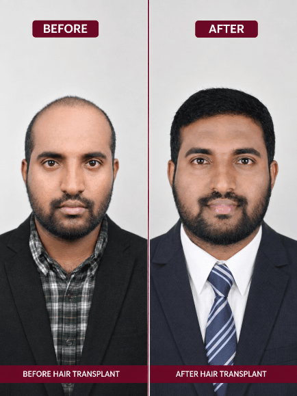 Hair transplant before and after result