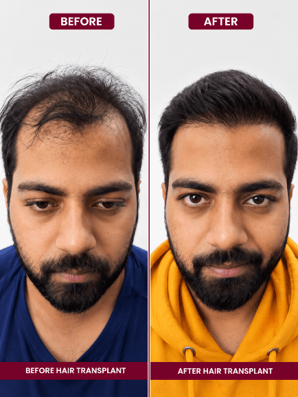 Hair transplant before and after result