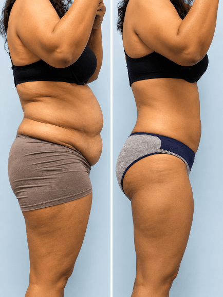 Liposuction before and after result