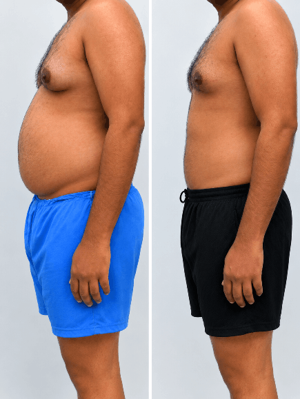 Liposuction before and after result
