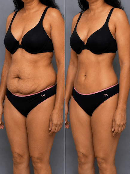 Liposuction before and after result