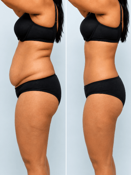 Liposuction before and after result