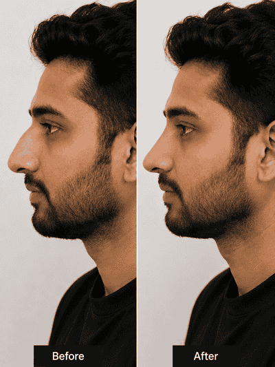 Nose surgery before and after result