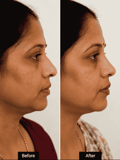 Rhinoplasty surgery before and after result